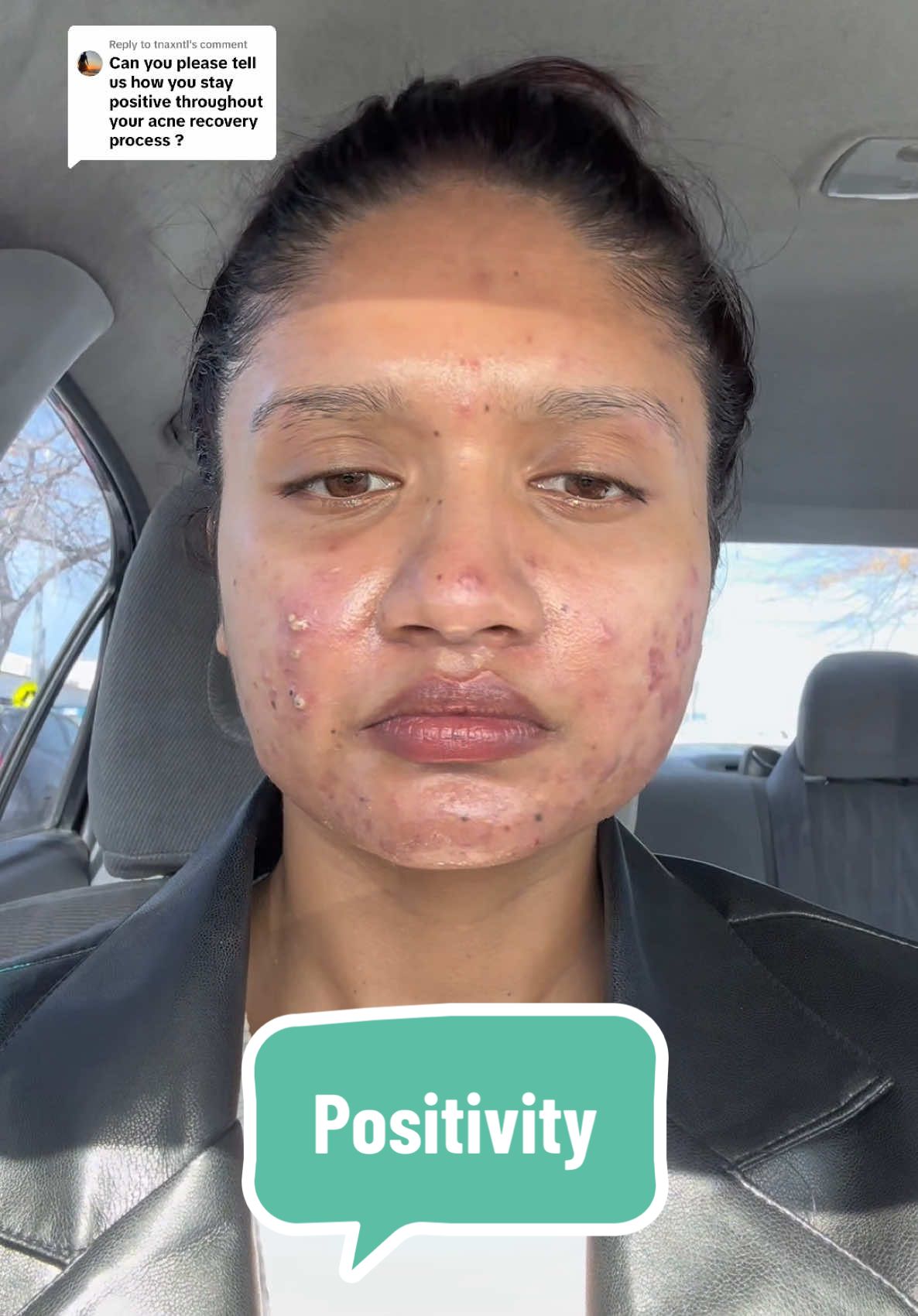 Replying to @tnaxntl If you’re struggling with your skin right now, just know… it’s okay to have hard days. You’re stronger than you think💪💪 #acne #acnepositivity #acneproneskin #acneskin #selflove #MentalHealth #SelfCare #cysticacne 