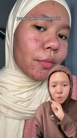 ga nyangka dulu pernah separah ini jerawatnya🥹 #acnemoisturizer #glowsophy 