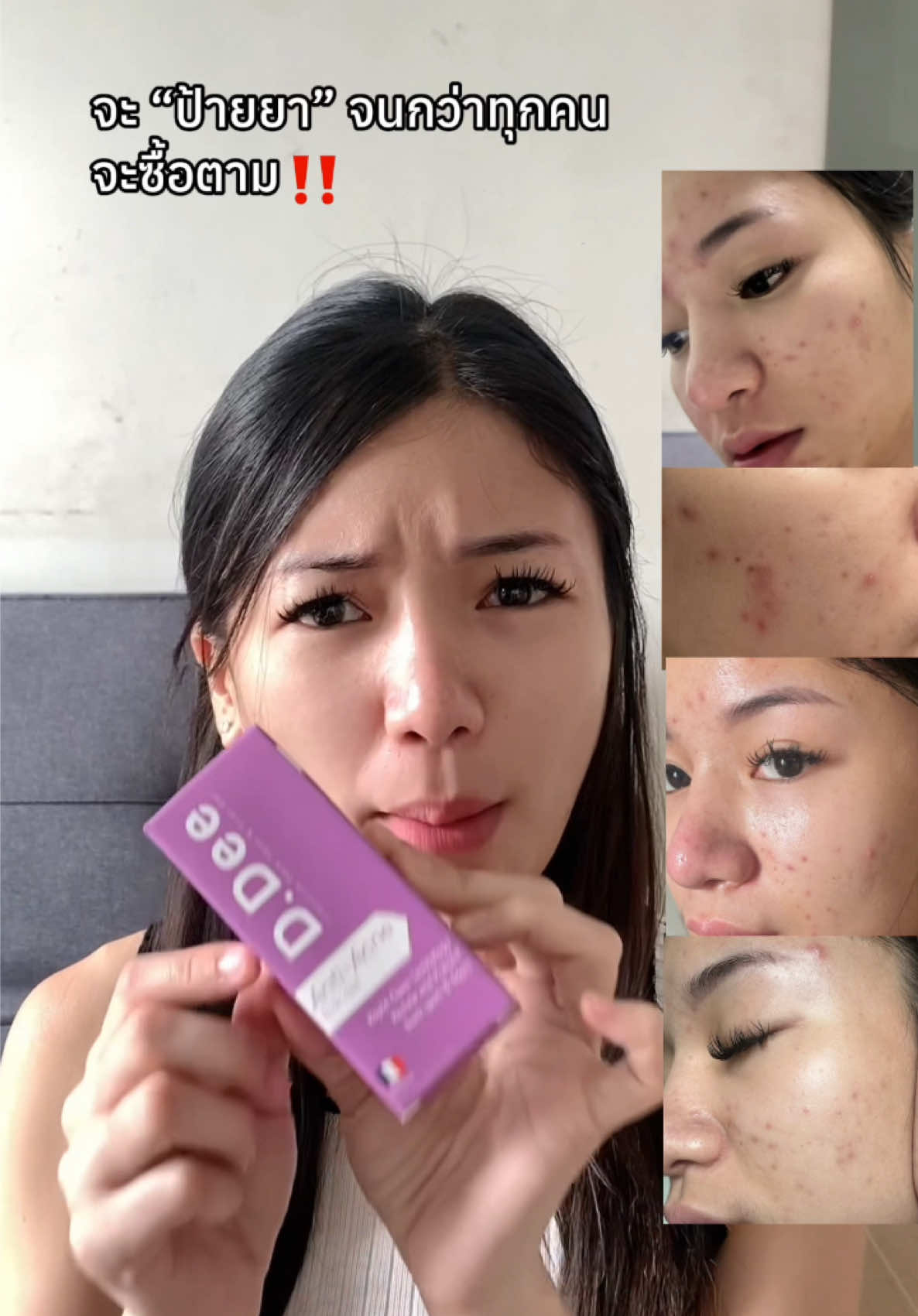 ที่สุดดดด💗 ผิวหน้าดีขึ้นได้เพราะ D.Dee จริงๆ ใครไม่ซื้อตามก็คือพลาดมากกกก 🧖🏻‍♀️ @D.Dee Official  #ddee #รีวิวddee #เจลลดรอยddee #เจลลดรอย