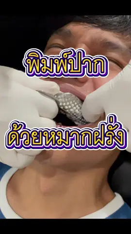 คุณจะพิมพ์ปากด้วยหมากฝรั่งกันไหมผมขอถาม (chewing-gum-impression) #ทันตะ #dentist