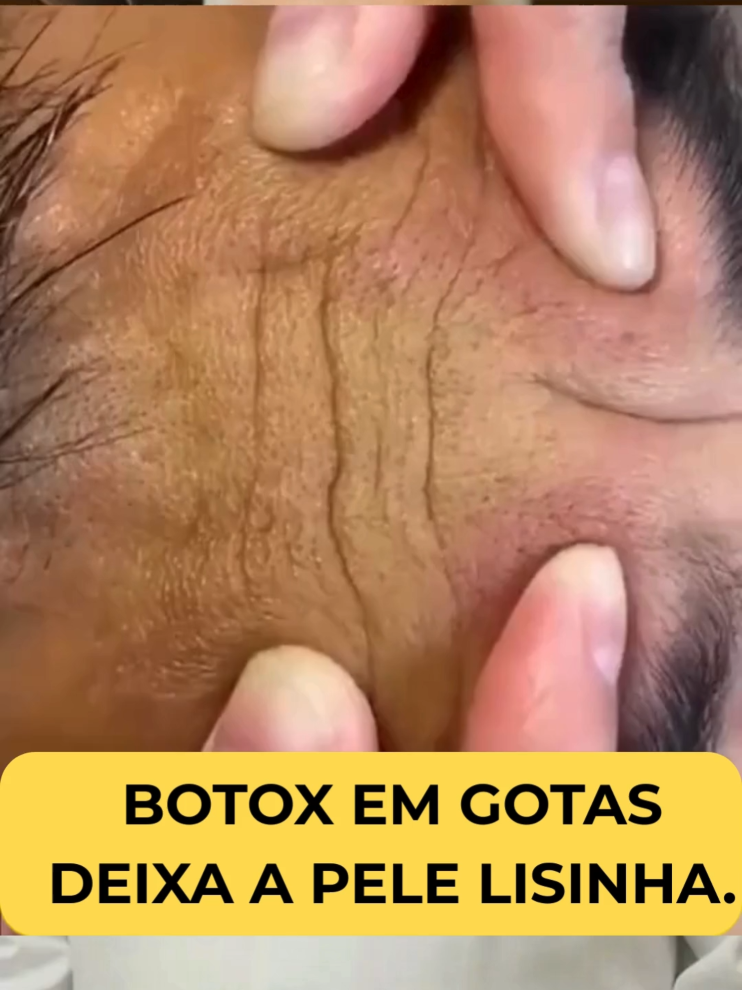 O site do tratamento está no meu perfil! #pelesaudavel #acidohialuronico #pelehidratada #mulheres #bigodechines #rejuvenescimentofacial #rejuvenescer #resveratrol #transresveratrol #skincare #tratamentofacial #pelesemrugas #calcificacao #mulher #vitaminac #rejuvenescimento #pelesemmanchas #mulhertrans #pele
