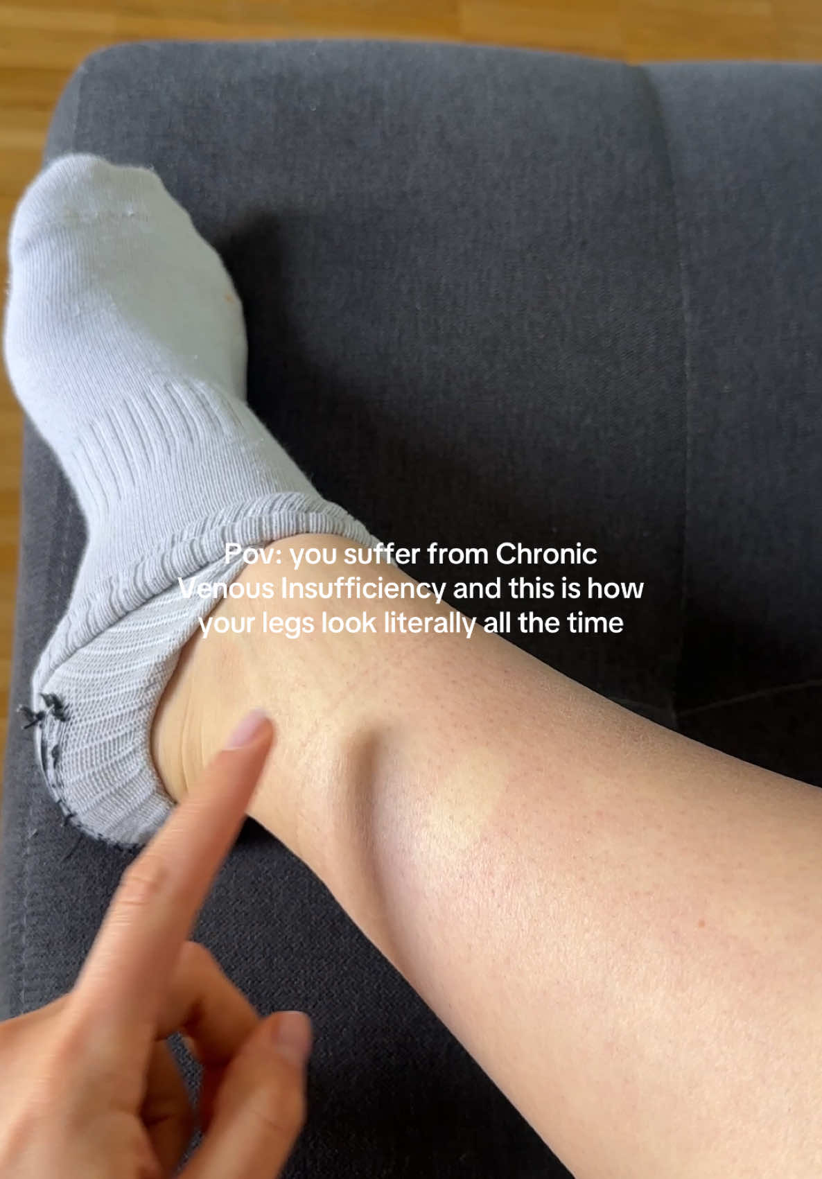 I was diagnosed with edema and superficial venous insufficiency, common symptoms are: - heaviness feeling in legs - redness - cramps  - spider veins (or varicose veins in worst cases) - swelling If you have similar symptoms it’s better to get checked, as the condition might worsen if not treated. #fyp #cvi #condition #edema 