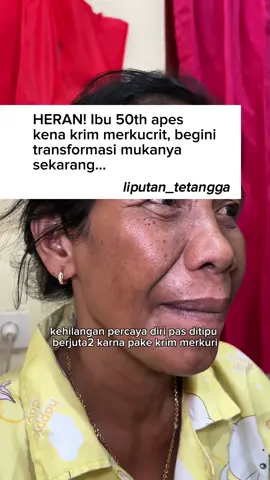 Apes kena krim merkucrit, ehh sekarang mukanya jadi gini 😩 #facemask #maskerwajah #skincare #antiaging #kerutan #fyp #glassskin #glowing 