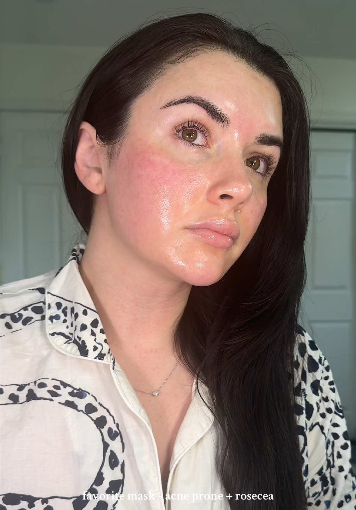 my favorite masks as an acne prone + rosecea girl #pdrn #rosecea #glassskin #koreanskincare    l 