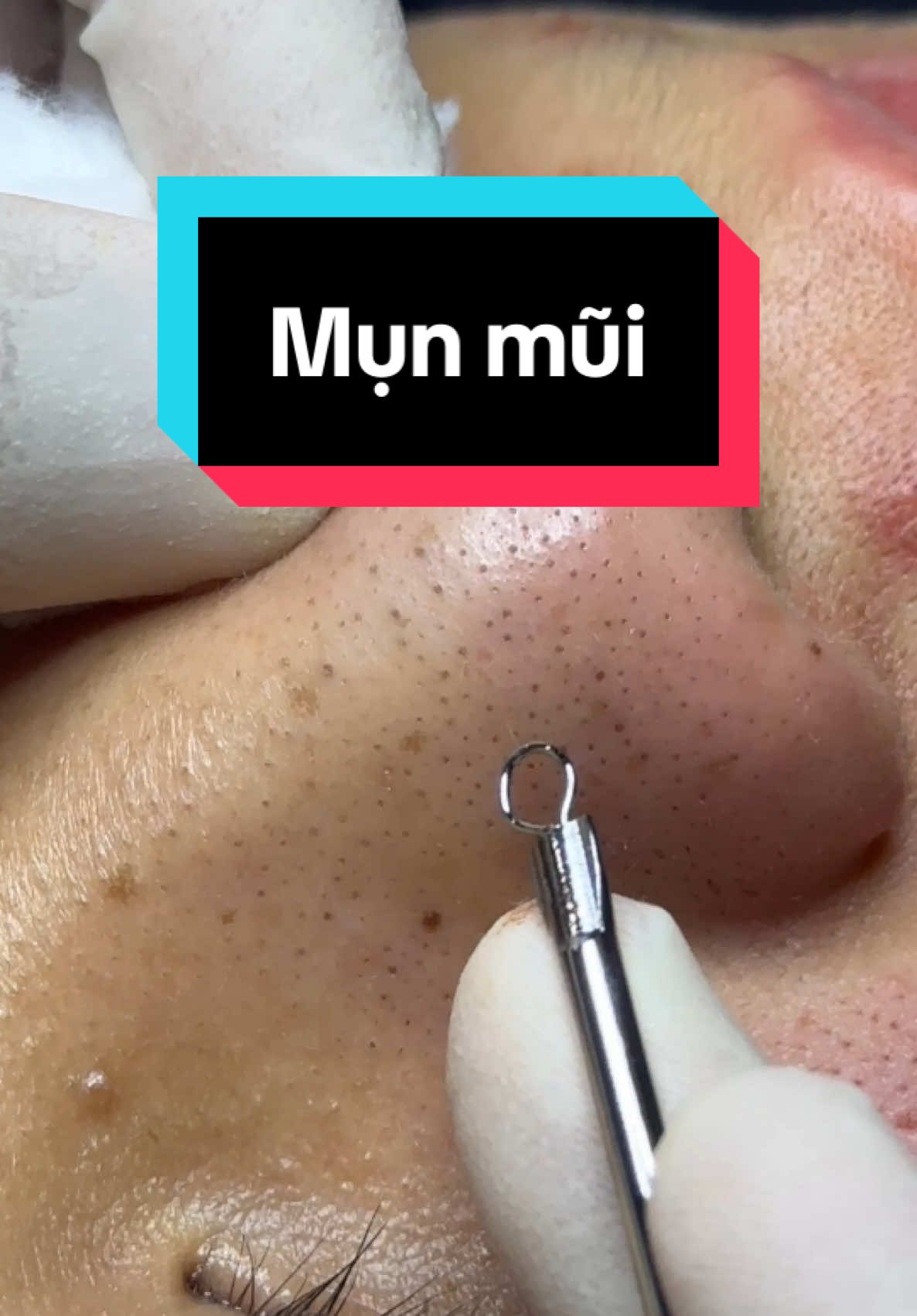 Mụn mũi #winspavungtau #trimunvungtau #nanmunvungtau 