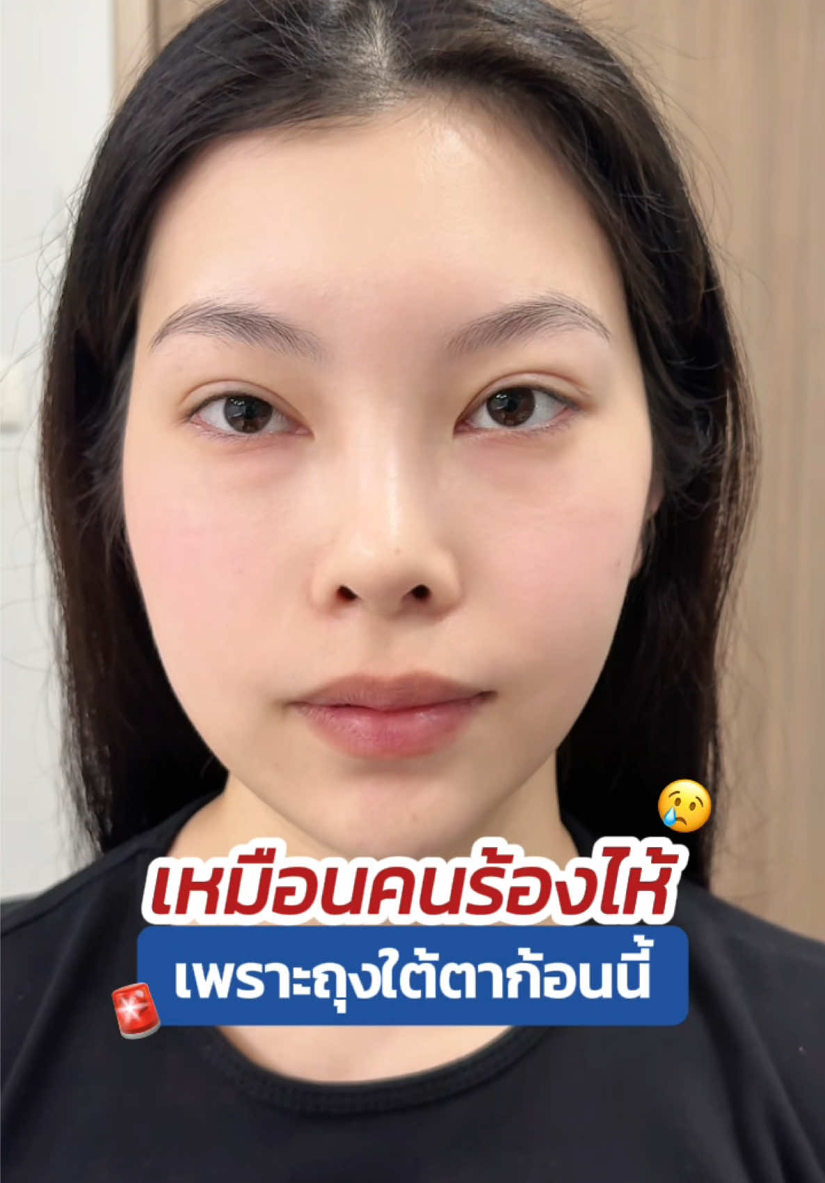 เหมือนคนร้องไห้ 🚨 เพราะถุงใต้ตาก้อนนี้ 🥹 #skyclinic #จักษุแพทย์ #ทำตาที่ไหนดี #babylock #สกายคลินิก #กำจัดถุงใต้ตา #ดูดถุงใต้ตา #หมอสกาย 