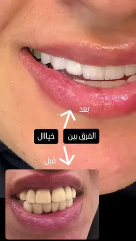 #ابتسامة_هوليود #الرياض #عيادات_الرياض 