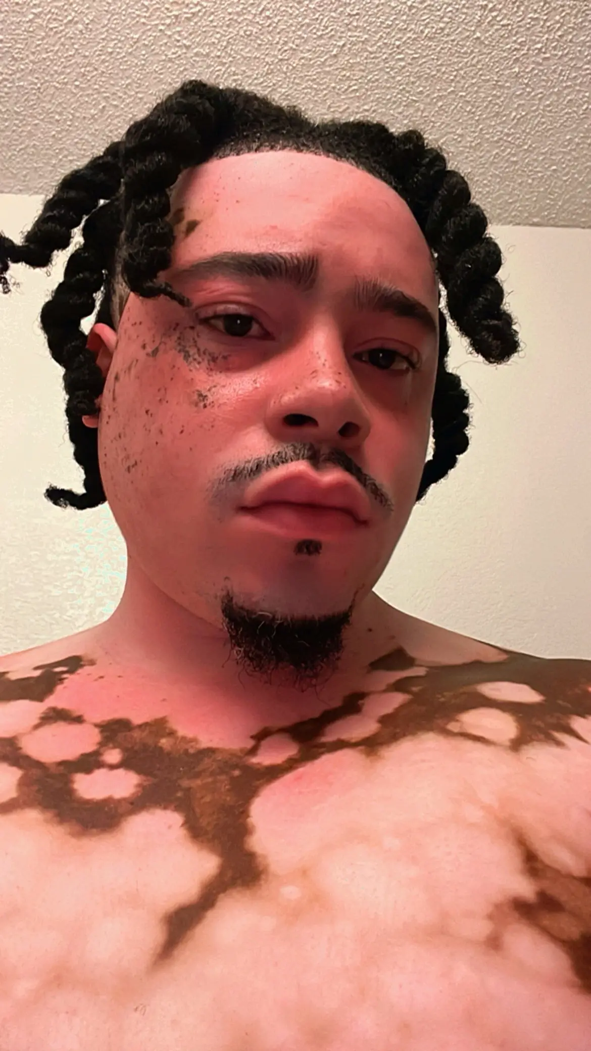 👿 #lilbeino #vitiligo #vitiligobeauty 
