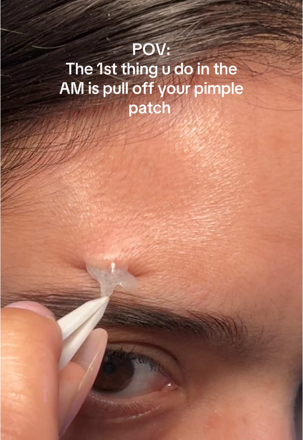 The best feeling TBH🥰 #pimplepatchpeel #pimplepatches #pimplepatch #pimplepatchremoval 