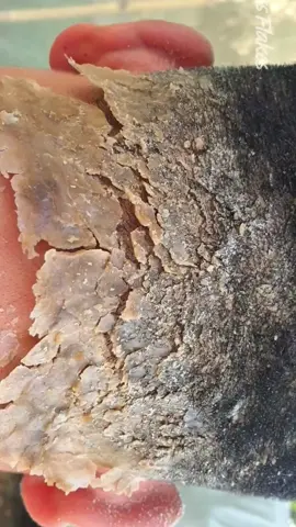 Hugeflakes dandruff cleaning  #DandruffScratching #ItchyDryScalp #HugeFlakes #Dandruff #dandrufftreatment #satisfying #dandruffremoval Disclaimer: Videos do not show original Dandruff,they are used for education purpose. Thank You,,,