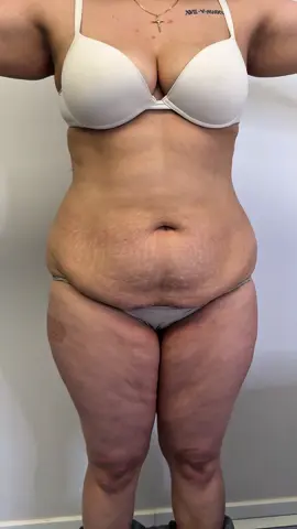 🖤 #lipo #abdominoplastia #dermo #dermolipectomia 