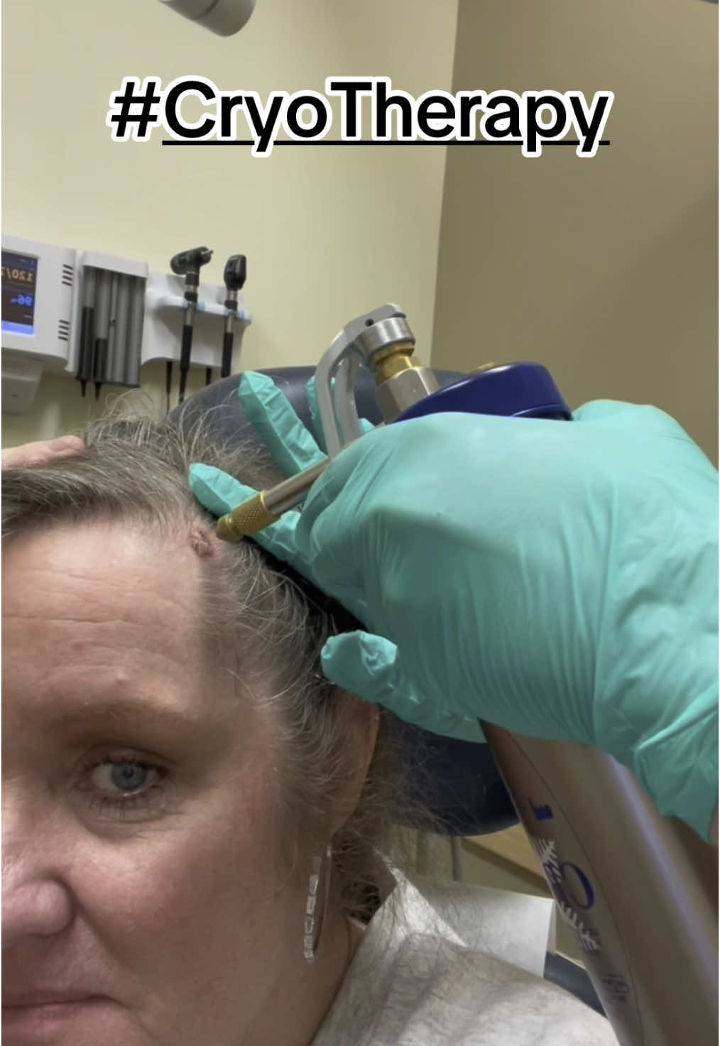 #cryotherapy #liquidnitrogen Take care of your skin people! This could be avoidable 