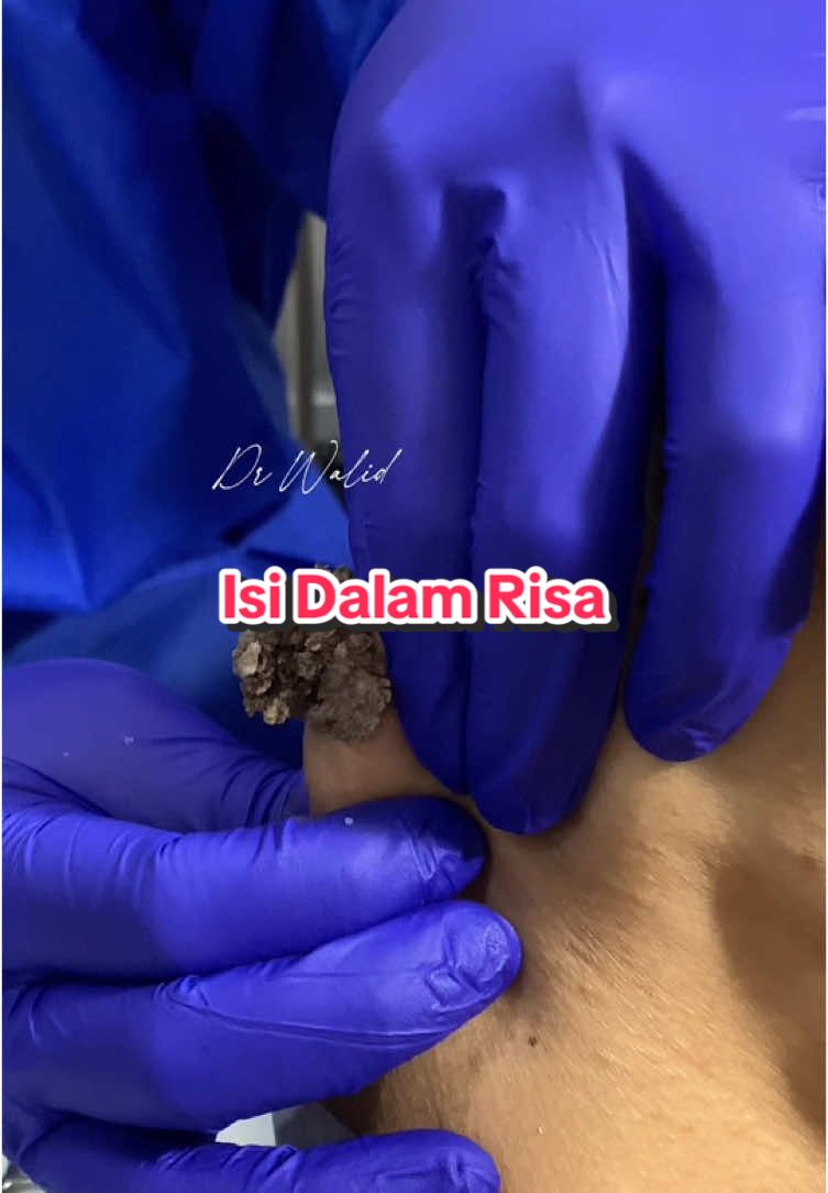 eeee ni Dr Walid buang sekali kantung tau . ini bukti! kalau nak buang risa/cyst harus wajib buang dengan kantung sekali supaya tak naik semula ☺️✨ Boleh pm kami atau tekan link di bio untuk appointment dengan Dr Walid ✅  #PoliklinikWalid #fyp #KisahBenar #minorsurgerykl #drwalid #minorsurgerypenang #risa #cyst #sebaceouscyst 