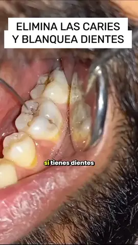 No más caries desde que uso esto todos los días 😁 #CuidadoBucal #freshmile #freshmileoralcare #freshmiletoothpastetables #dental #fyp #SonrisaSaludable #HigieneBucal
