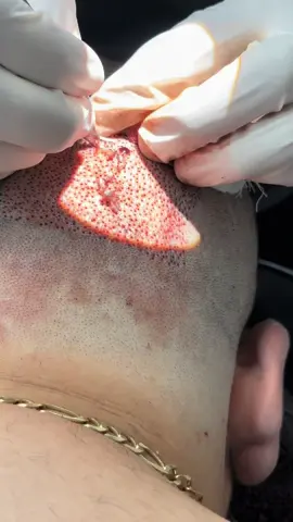 Así se ve de cerca una Extracción de Cabello para un Injerto Capilar: #cabello #injertocapilar #cuidadodelcabello #tratamientosparaelcabello #pelo #medico #mexico 