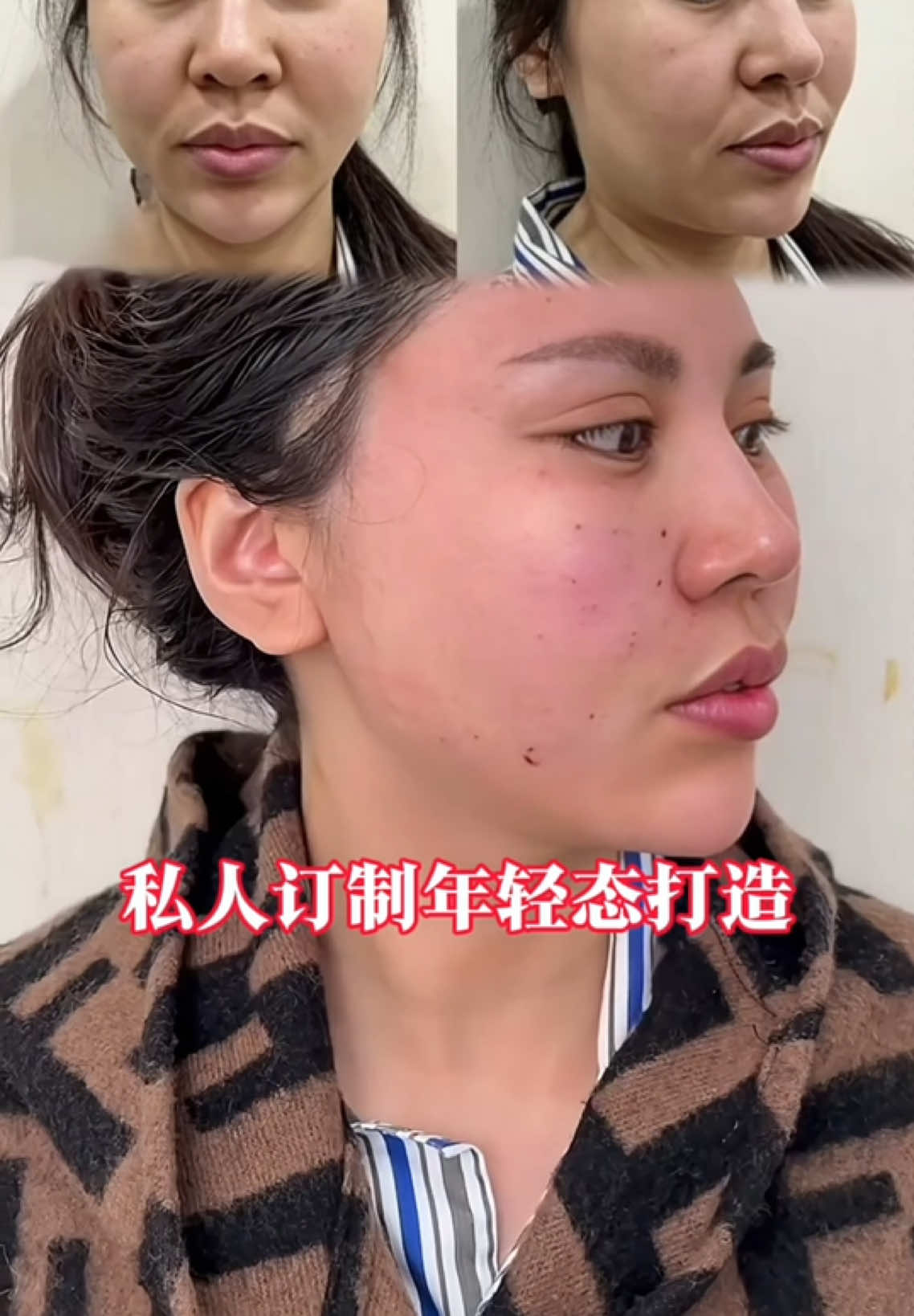 法令紋不見了#面部提升 #筋膜提升 #拉皮 #facelfit 