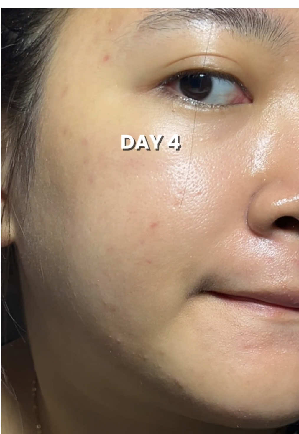 ternyata 377 se bgss ini buat bekas jerawat ??!! 😤❤️‍🔥 #moisturizer #377 #skintific #darkspots #acnetreatment 