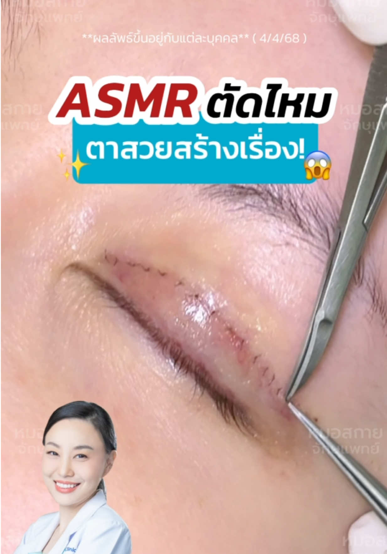ASMR ตัดไหม ✂️ ตาสวยสร้างเรื่อง #หนังตาเยอะ #แก้ตาสองชั้น  #หมอสกาย #จักษุแพทย์ #หมอตา #skyclinic  #ศัลยกรรมตา #รีวิวตาสองชั้น #สกายคลินิก  #ทำตาที่ไหนดี #เคสแก้ตา #ตาสองชั้นหลบใน