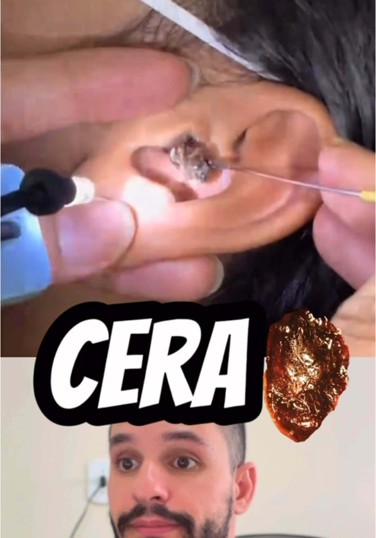 Quais as causas do cerume impactado? As causas de cerume impactado podem estar relacionadas a: * uso de hastes flexíveis (cotonetes) em muita profundidade no ouvido; * uso constante de fones de ouvido; * infecções; * idade – pessoas idosas podem apresentar cerume impactado com maior frequência. O problema também pode aparecer sem causa aparente, algumas pessoas simplesmente produzem cera de ouvido em excesso.  Quais são os sintomas de cerume impactado? O cerume impactado pode causar: * sensação de ouvido abafado; * zumbido; * tontura; * coceira na região; * dor de cabeça; * perda de audição.