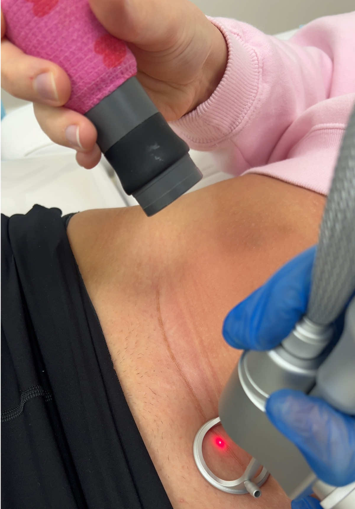 C-section scar? Watch it fade with each CO2 laser session — clearer, smoother skin is coming! #CSectionScar #CO2LaserTreatment #ScarRemoval #PostpartumSkin #LaserForScars #SkinHealing #MumBodyConfidence #StretchMarkAndScarCare #DermalClinic #BeforeAndAfter