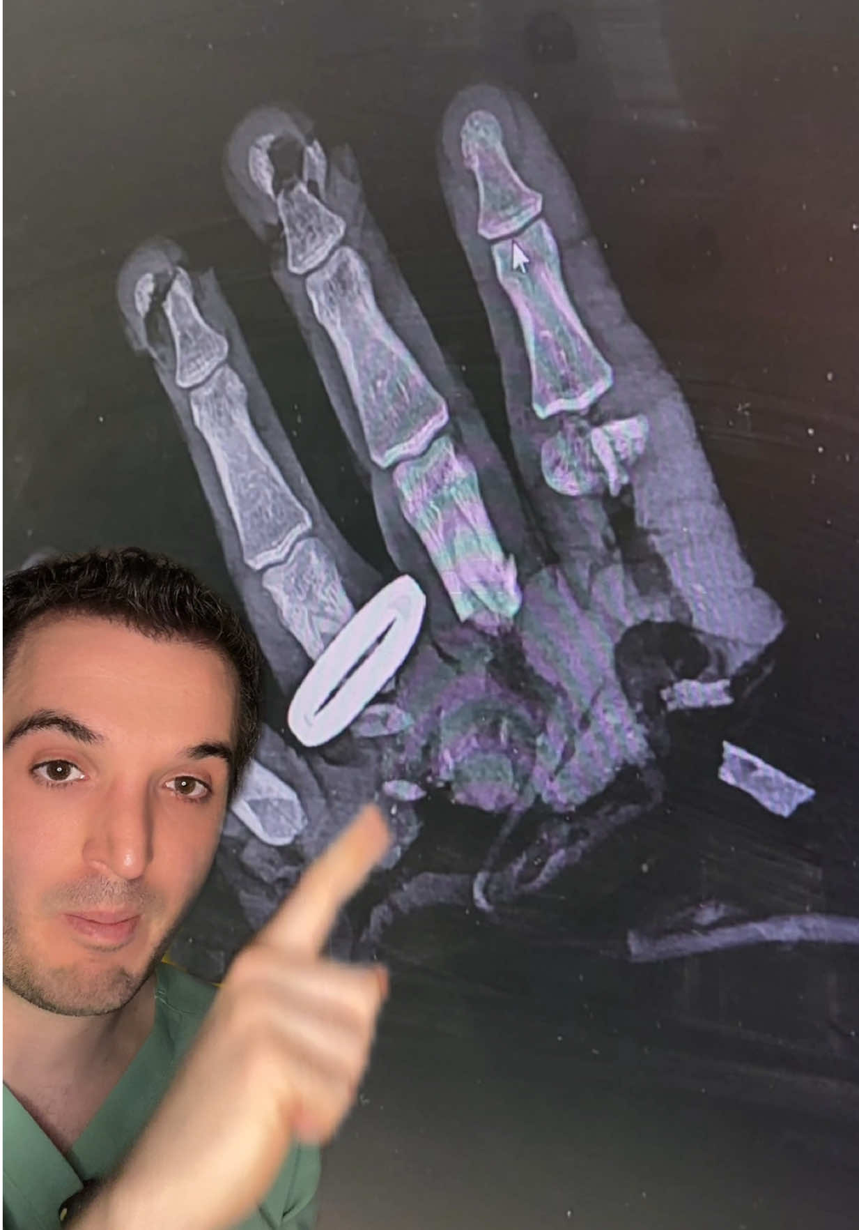 Radiology Case of the Day. Hand x-ray. Answer at the end. _________________________________ #medicine #doctor #doctors #radiology #radiologist #radiologia #doctorsoftiktok #medstudent #medicalstudent #medschool #medicalschool #AIinhealthcare #medtok #doctorlife #tiktokdoc #tiktokdoctors #SiemensHealthineers #butterflyIQ #tempusAI #radAI #RadiologyReimagined #Stryker #Medtronic #AIDoc #Barcogram #hyperfine #bodyspec #prenuvo #ezrascan #DragonMedicalOne #MModal #abbottglobal #healthtech #healthIT #wearfigs #greenscreen 
