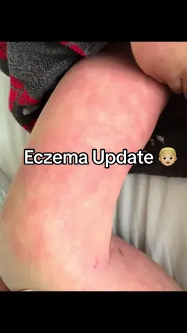 It’s been a long couple of months, Jax is currently on a 50 day course of oral steroids due to the constant flare of his skin - I know some people will not agree with this but Jax’s itch is all based internally and we have tried various routes to try and calm this down. He will be starting methotrexate in hopefully May, he just needs to have his second dose of the chicken pox vaccine and then 2 weeks after we can start this.  I’m really hoping this helps, this was a hard decision to make as a family but we feel this is the only thing we can do for Jax to be comfortable and not constantly itching and to help with concentrate better. His itch is so upsetting to watch as it distracts him so much and really hurts his skin, trying to explain to a 4 year old to itch on top of his clothes isn’t easy and he gets just as frustrated.  I wish I could take this away from him 🤍 #eczemaawareness #eczematok #mumsoftiktok 