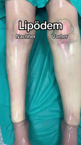 🇩🇪 Laser-assistierte Liposuktion bei Lipödem nach der S-thetic Methode 🇬🇧 Laser-assisted liposuction on a lipoedema patient   