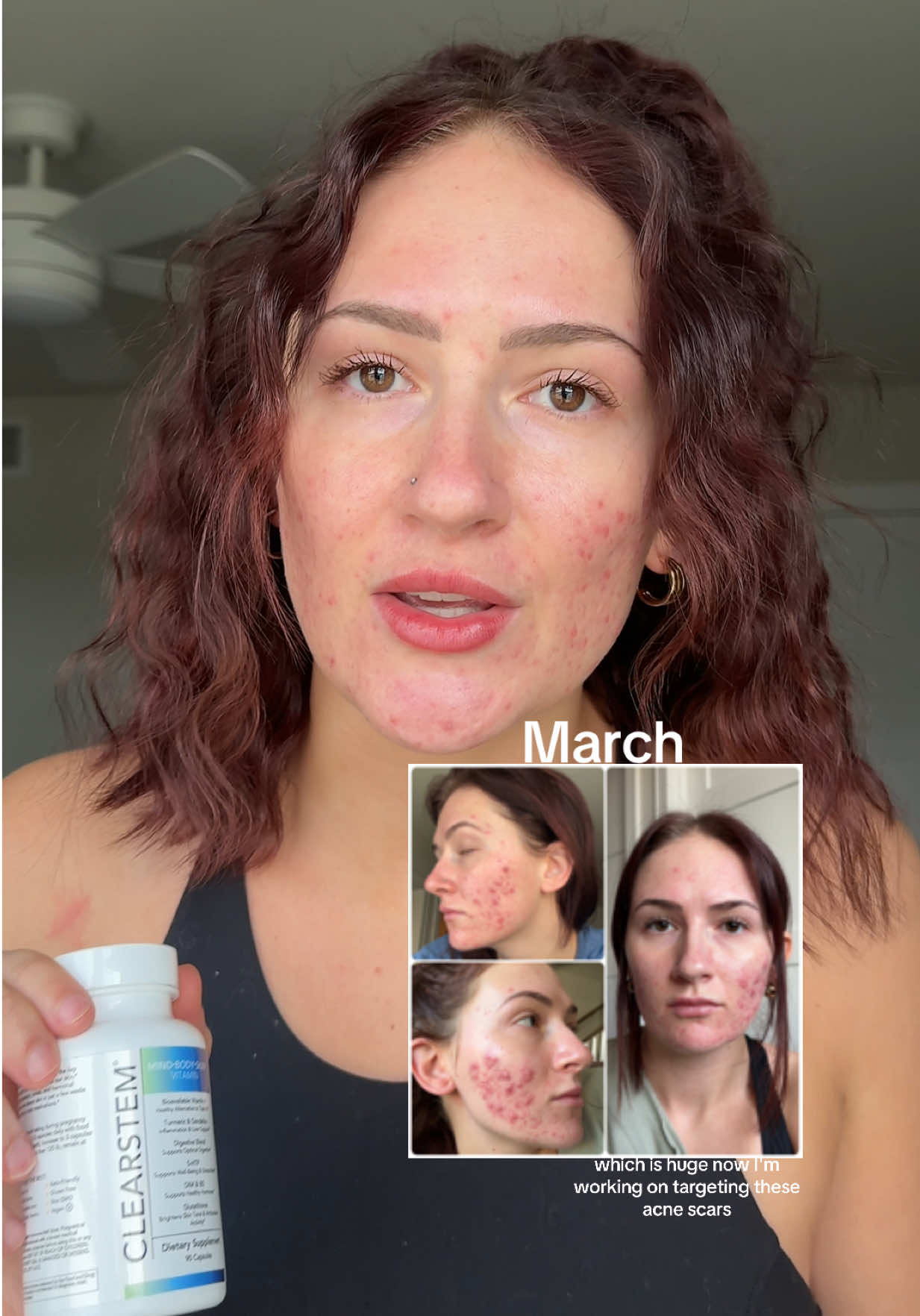 I’ve struggled with adult acne and hormonal breakouts for a while. @CLEARSTEM Skincare’s Mind Body Skin supplement has been a game changer. My breakouts are finally under control, and now I’m focusing on healing the scars. Clear skin is finally feeling possible! #clearstemskincare #clearstemresults #mindbodyskin #mindbodyskinreview #adultacnehelp #hormonalbreakouts #hormonalacnejourney #acnejourney #acnesupplements #hormonalacnesupplement #hormonalbreakouts #balancehormones 