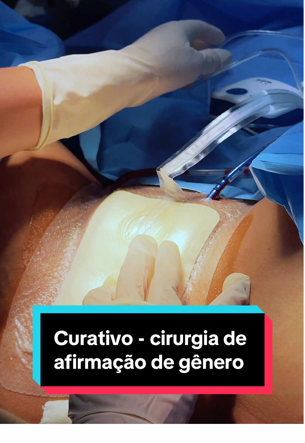 No pós-operatório da cirurgia de redesignação sexual, cada detalhe faz diferença — e o curativo também. Utilizamos um curativo a vácuo, que oferece mais autonomia para a paciente e acelera a cicatrização. O material especial ajuda a absorver o edema, evita infecções e ainda estimula a formação de novos vasos sanguíneos, acelerando a recuperação. Tecnologia a serviço do cuidado e da segurança em cada etapa do processo. 📲 (21) 98879-2251 📲 (21) 9 9629-2919 📍Botafogo/Barra da Tijuca-RJ #RedesignaçãoSexual #PósOperatório #SaúdeTrans #CuidadoEspecializado #AiltonFernandes #CirurgiaTrans #curativo #cuidados #trans #urologia #mudancadesexo #afirmacaodegenero 