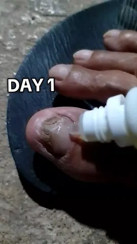 SIRANG KUKO NO MORE🤭 #nail #nailrepair #kuko #paanopagalinginsirangkuko  #sirangkuko #gingernailessence #gingernailrepair 