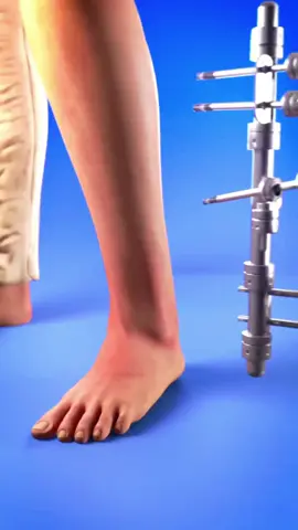 Broken Leg 🦵 Surgery. Health tips and Quotes 💛 #healthylifestyle #healthyfood #healthfact #healthy #healthtips #food #facts💯 #doctor #healthylifestyle #HealthTips #HealthyLiving #WellnessJourney #SelfCareTips #StayHealthy #FitnessMotivation #WorkoutTips #StayActive #HomeWorkout #FitLife #HealthyEating #EatClean #nutritiontips #Superfoods #BalancedDiet #Mindfulness #MentalHealthMatters #StressRelief #SelfCareRoutine #PositiveVibes #TikTokHealth #LifeHacks #DailyTips #ForYou #FYP #fypシ゚viralシ #fypシ #reels #video #hijab  #viral #trending #foryou #videos #Queen #fypシ #viral #viralvideo #foryou #foryoupage #poetrystatus #poetry #01_doctor #trending #quotes #tranding #onthisday 
