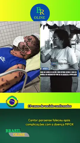 cantor paraense faleceu com MPOX . . . . . #noticiastiktok #jornalismo #ultimasnoticias #noticias #variola #mpox #paraense #para #cantor 
