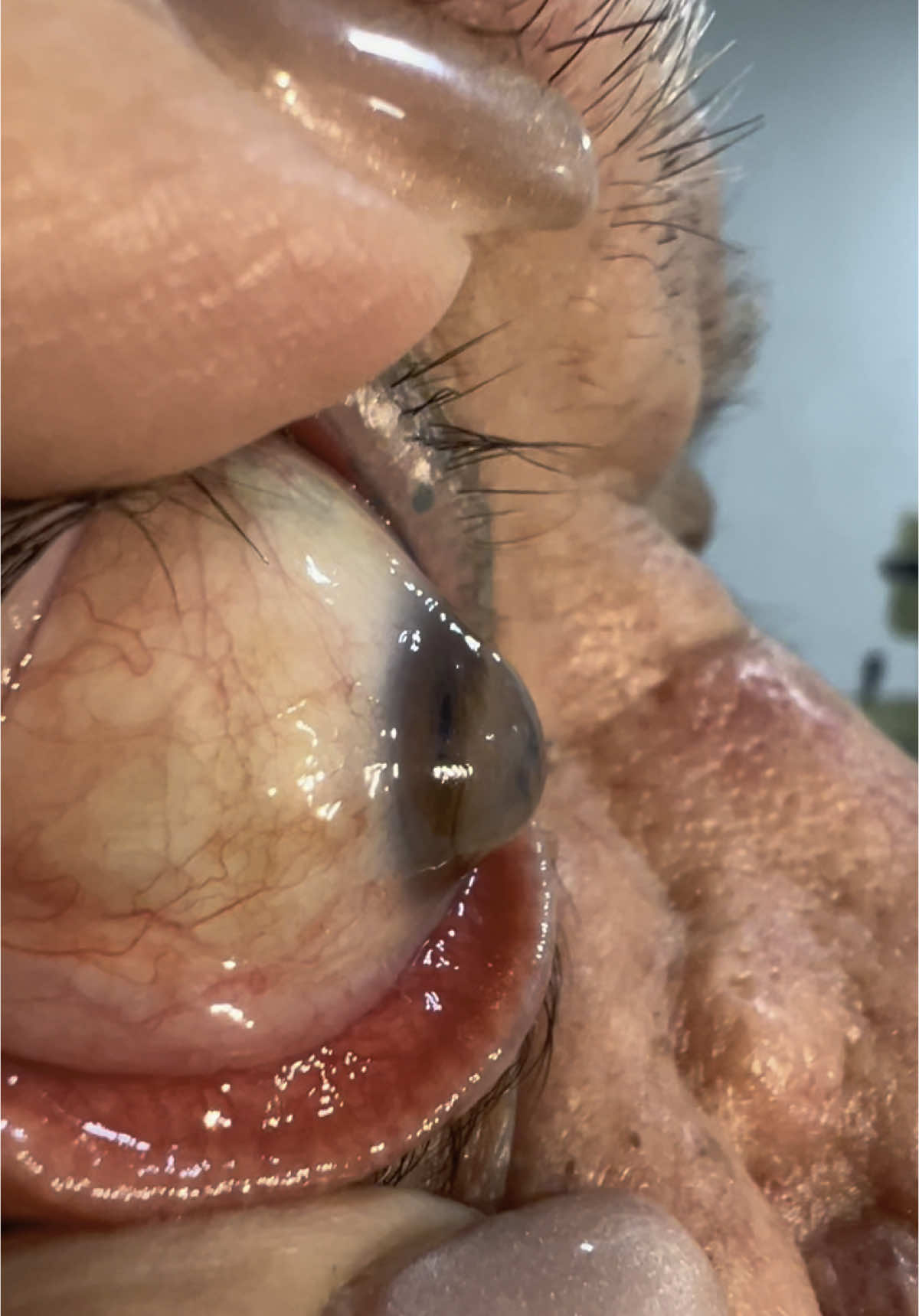 Cuida tus córneas ! Muchos no lo saben pero el astigmatismos en evolución condiciona la calidad de visión y de vida en los pacientes que lo padecen, si no se hace un seguimiento y un tratamiento temprano para su control, puede terminar en algunos casos en ectasias como el queratocono, y en otros necesitar un transplante de cornea. 