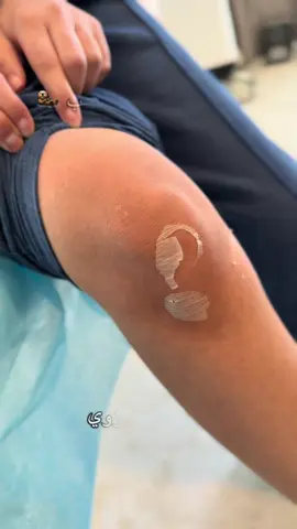 #searchinsightcreators جلسة تقشير لمنطقة الركب للتخلص من تصبغات الجلد و الحصول علي جلد اكثر نعومة و حيوية ❤️#الشعب_الصيني_ماله_حل😂😂 #ليبيا_طرابلس_مصر_تونس_المغرب_الخليج #ليبيا_طرابلس_مصر_تونس_المغرب_الخليج #علاج_تصبغات_البشرة #تقشير_كيميائي 