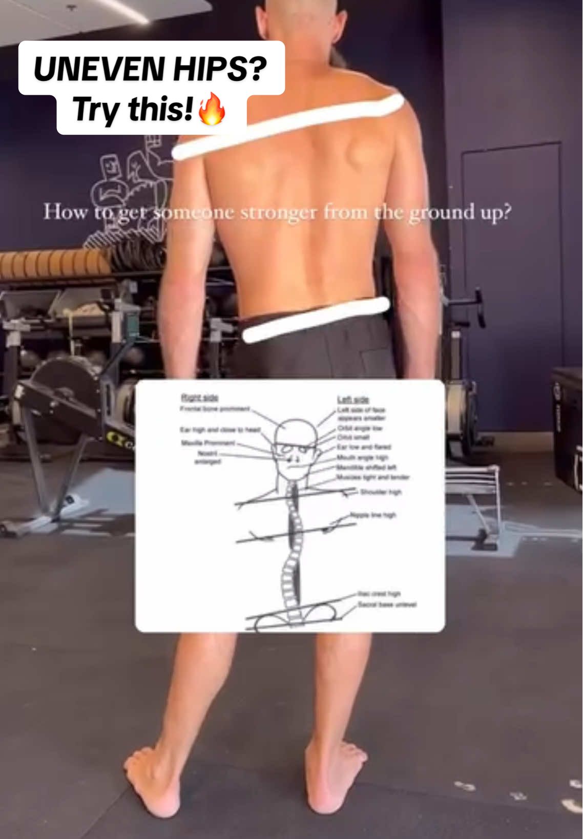 👁️ To build a solid and strong base, it's essential to first address any body misalignments. #unevenhips uneven hip alignment  📍Correcting misalignments ensures that you're building strength and stability on a balanced foundation. 📈By focusing on alignment, you'll optimize your movement patterns, enhance mobility, and create symmetry across the body - - - - - - #posture #hips #spinehealth #spine #bodyalignment 