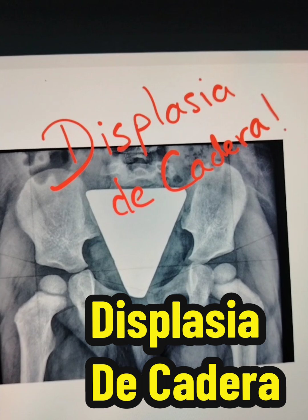 Linea del desarollo de las caderas segun el TCR Displasia de Cadera #terapia #fisioterapia #traumatologia #ortopedia #infantil #pediatria #displasia #displasiadecadera #cadera  #salud #awards #paratiiiiiiiiiiiiiiiiiiiiiiiiiiiiiii 