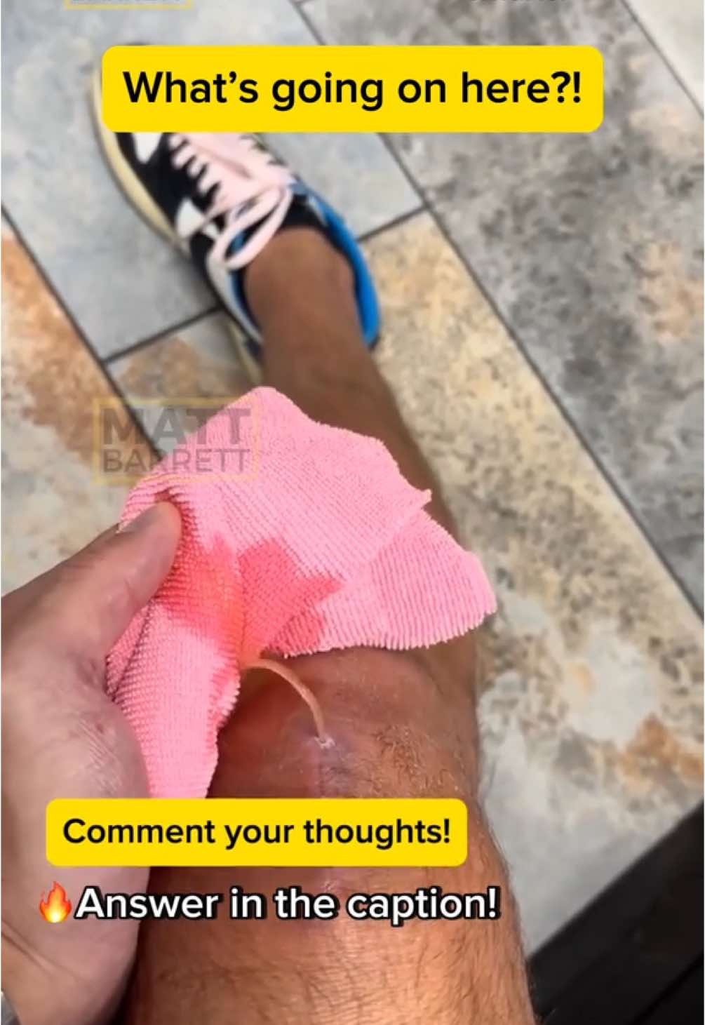 ⚠️ Tap here for the answer! ✅ Spoiler alert: knee seroma What can we see… ☑️ Knee ☑️ straw coloured fluid ☑️ a surgical scar This is a knee seroma! … a collection of clear (serous) fluid in or around the knee. It’s typically caused by trauma, surgery, or inflammation, often presenting as swelling without infection. Serous fluid is an ultrafiltrate of blood plasma. The overlying skin has not healed properly, leading to a direct channel for the serous fluid to leak out of. 🔥 Did you get it? Follow me Dr Matt Barrett to study medicine smarter! #doctor #nurse #mbbs #medstudebt #usmle #medico