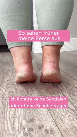 Sag Hornhaut den Kampf an mit Dermaglide! Der elektrische Hornhautentferner macht deine Füße in Sekunden glatt & weich – sanft, effektiv & perfekt für zu Hause. #Dermaglide #Hornhautentferner #Fußpflege #BeautyGadget #Pediküre #SelfCare #weicheFüße #Skincare #BeautyRoutine #TikTokMadeMeBuyIt 