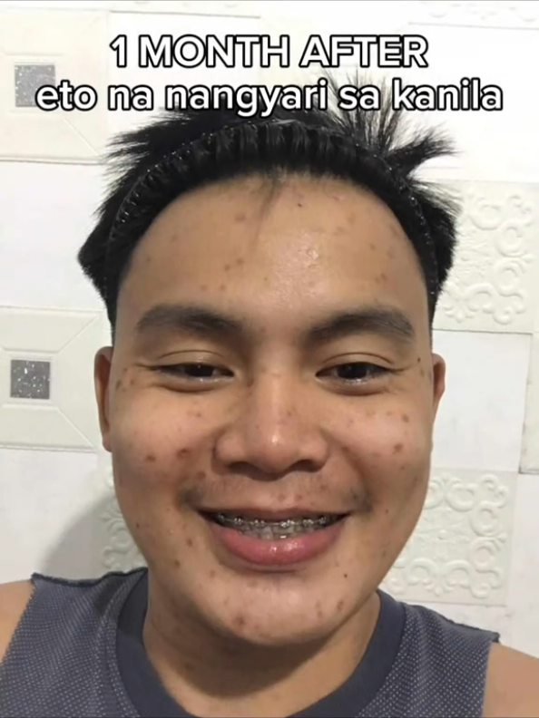 Di mo makikita ang effect kung hindi mo SUSUBUKAN 😍 watch mo tong videong ito! :) #BTY #BTYAdvance #YourGlowOurGoal #BTYfeedbacks #proven #Legit #btyinstaglow #btyovernightmask #peklatnomore #peklatremover #scar 