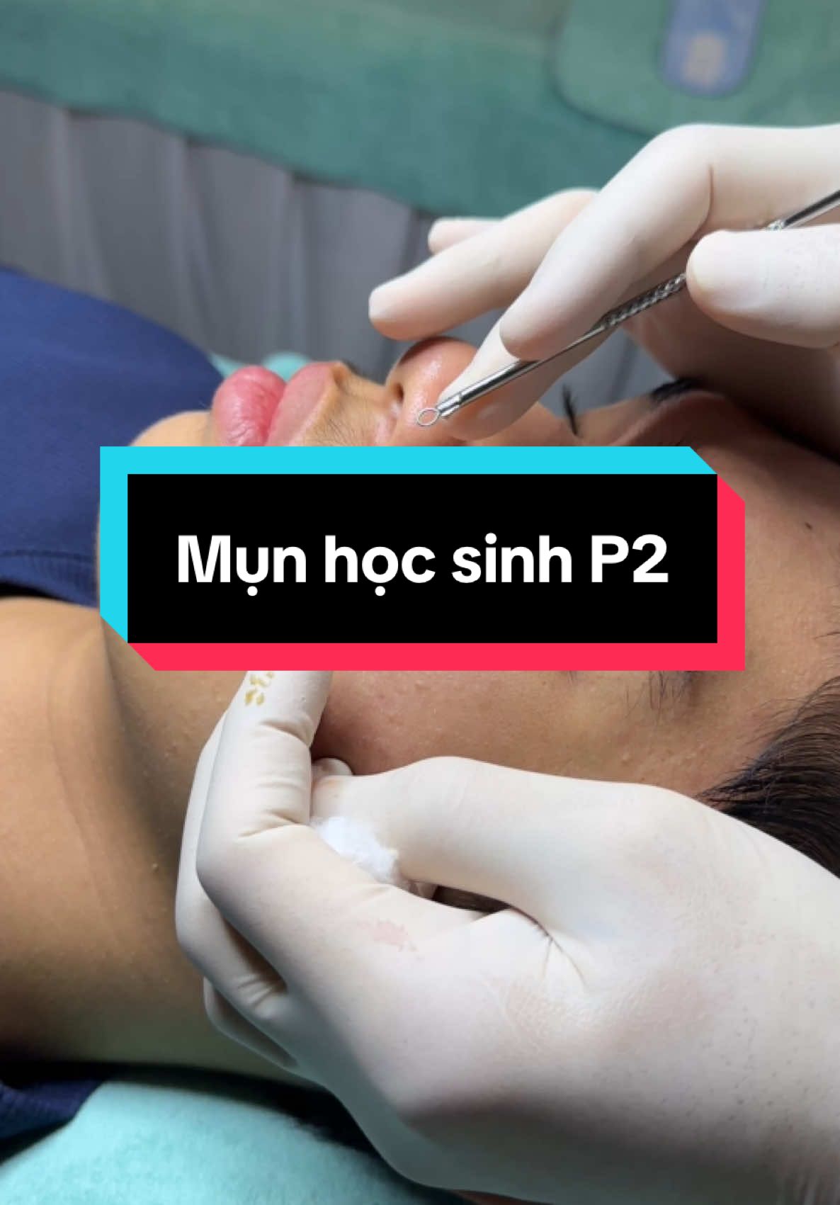 Mụn hoc sinh p2#winspavungtau #trimunvungtau #nanmunvungtau #nanmun #spavungtau 