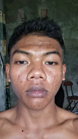 acneno ngebantu bgt buat aku sebagai acne fighter #acneno#acnejourney#acnefighter#skincare#acneno