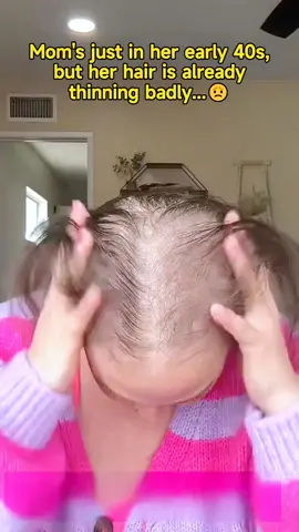 The #shampoo recommended by my doctor friend is really good. Friends with severe #hairfall must try it.#hairgrowth #antihairfall #bald#remimpi  #tiktokshopmothersday 