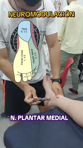 NEUROMODULACIÓN NERVIO PLANTAR MEDIAL CON POINTER. 📍⚡️ #tarso #foot #podologia #fisioterapia #neuromodulación #nervios 