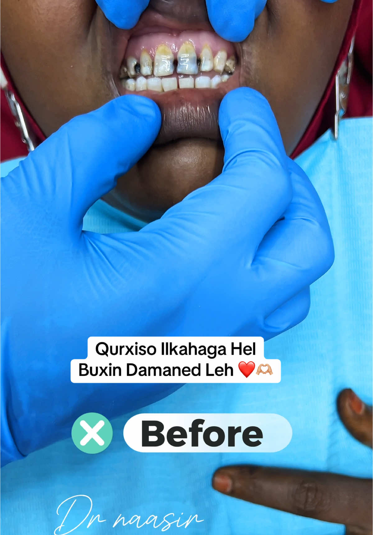 Qiima dhimis ayaa SocoTo Ka fa’ideysi wacan ❤️🫶🏼 #dentist #ilkaha #somalidentist #muqdisho #viral #somalitiktok #kakaaftooncabashada🇸🇴🦷🇲🇾  