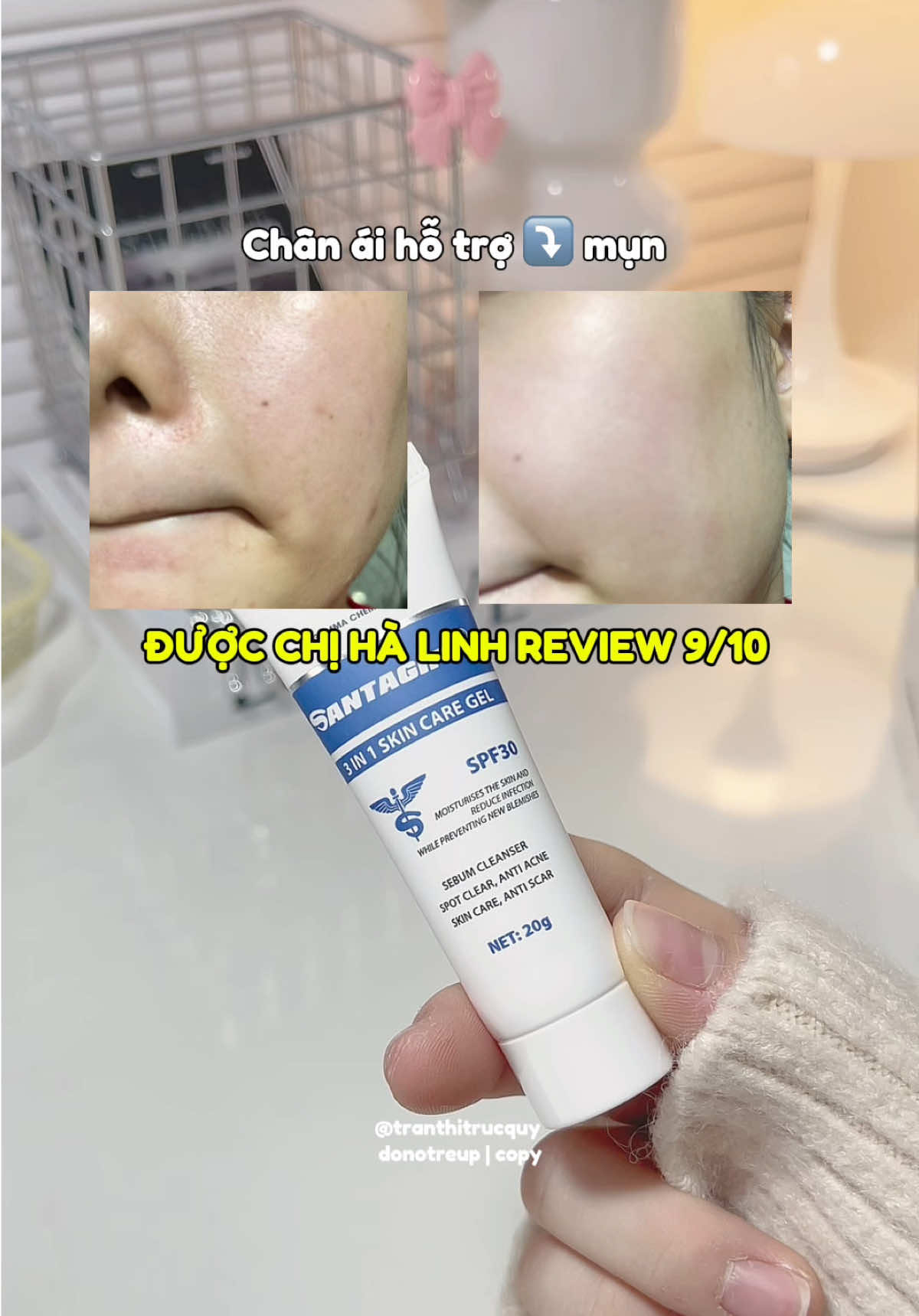 Chân ái cho những ai bị mụn nè 💯 #santagift #santagiftpro #geltrimun #gelmun #cratt #xuhuong #fyb #muataitiktok #viral 