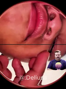 #asmr #babylove #nosecleaning #removalvideo #satisfyingvideo #foryou 