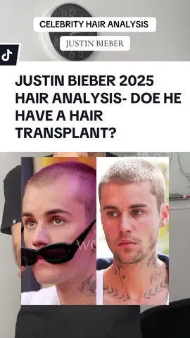 JUSTIN BIEBER 2025 HAIR ANALYSIS- DOE HE HAVE A HAIR TRANSPLANT? | #justinbieber #justinbieberhairtransplant #fuehairtransplant #justinbieberhair 