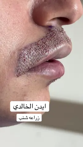 #ايدن_الخالدي #زراعه_دقن #زراعة #زراعه_الشعر #البوصيلت #زراعه_شنب #اكسبلور #زراعه_الشعر_في_تركيا #تركيه🇹🇷 #hair #libya🇱🇾 #suudiarabia #oman🇴🇲 #katar #kuveyt #ispanya #almanya #beforeandafter #hairstyle #hairtransplant 