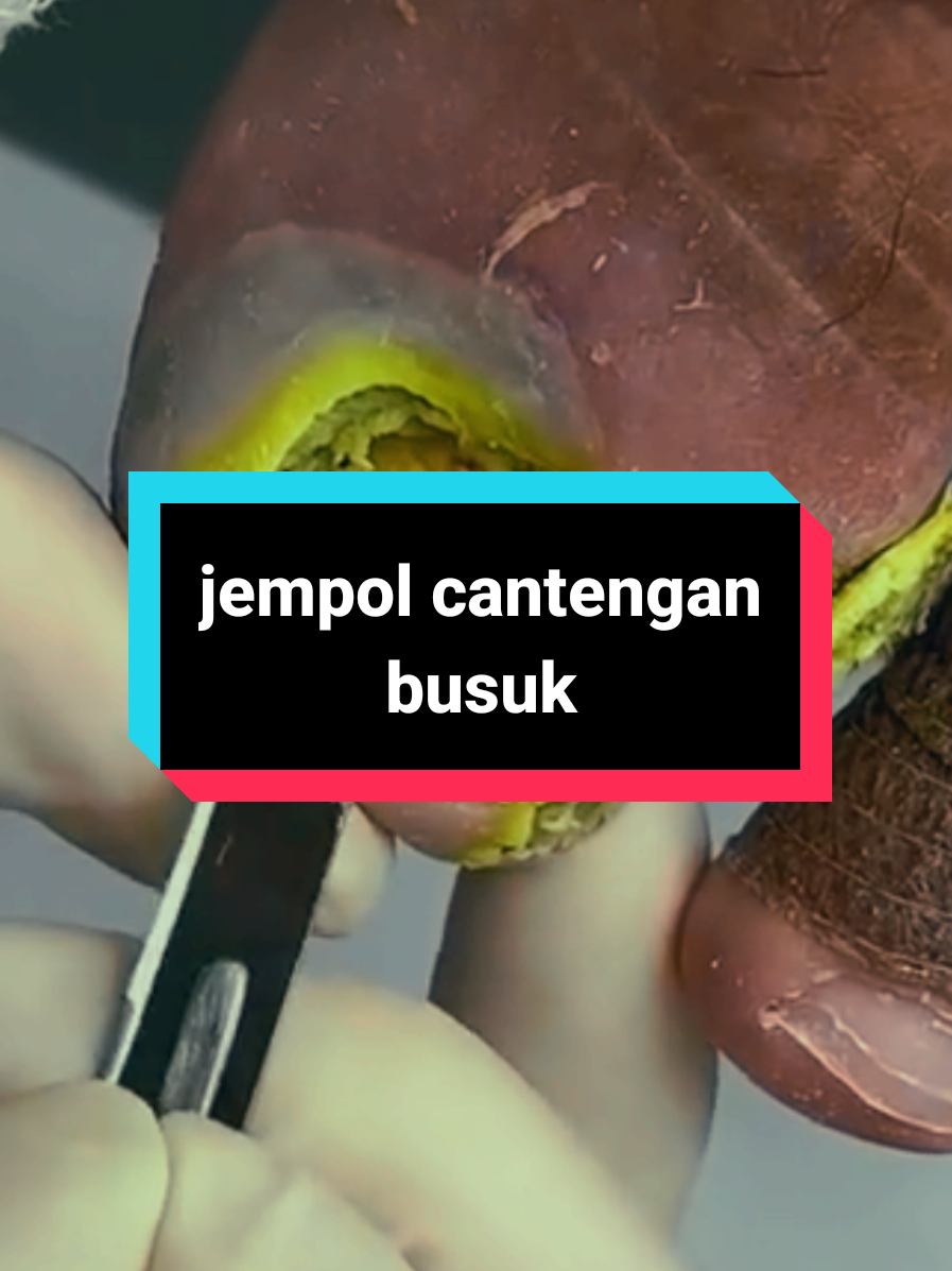 jempol cantengan busuk gara gara jadi sales pinjol #cantengan #onychomycosis #ingrowntoenailremoval #viral #fyp 