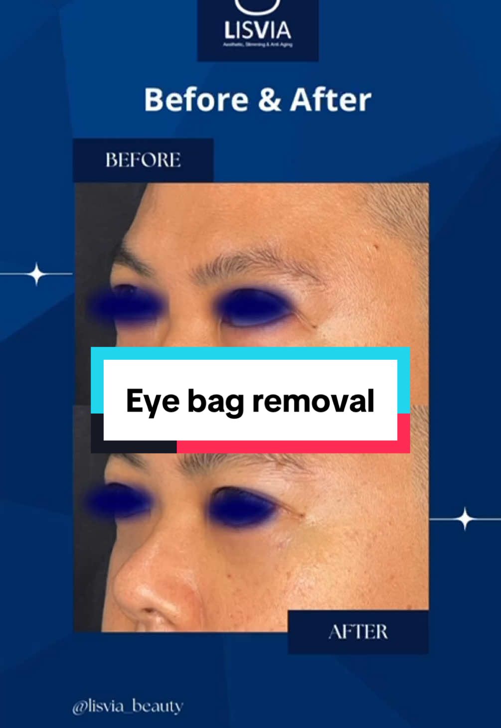 Menghilangkan kantung mata yang menjadi masalah untuk kaum pria. Dengan teknik tanpa penjahitan. Penyembuhan cepat, lebam minimal #dokterkecantikanmedan #klinikkecantikanmedan #eyebagremoval #minisurgery #kantungmata #fatremoval #eyetreatment 